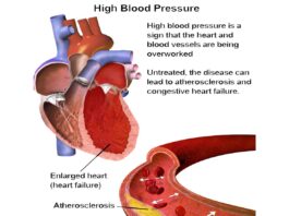 High Blood Pressure