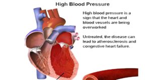 High Blood Pressure